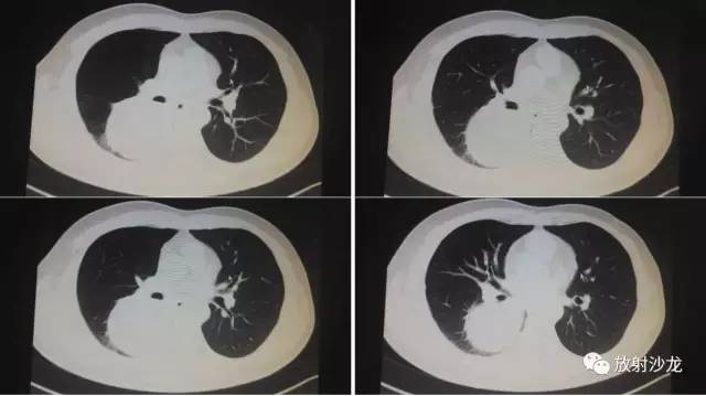 【病例】肺硬化性血管瘤1例CT影像讨论 【病例】肺硬化性血管瘤1例CT影像讨论