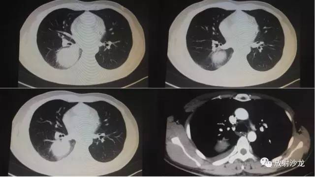 【病例】肺硬化性血管瘤1例CT影像讨论 【病例】肺硬化性血管瘤1例CT影像讨论
