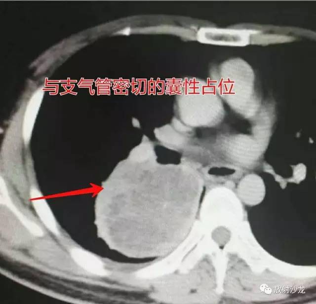 【病例】肺硬化性血管瘤1例CT影像讨论 【病例】肺硬化性血管瘤1例CT影像讨论