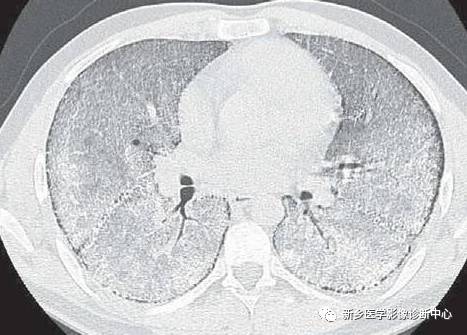 小心:6种症状体征与影像学表现不符的肺部疾病 小心:6种症状体征与影像学表现不符的肺部疾病