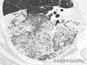 小心:6种症状体征与影像学表现不符的肺部疾病 小心:6种症状体征与影像学表现不符的肺部疾病