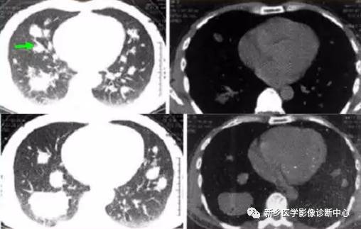 小心:6种症状体征与影像学表现不符的肺部疾病 小心:6种症状体征与影像学表现不符的肺部疾病