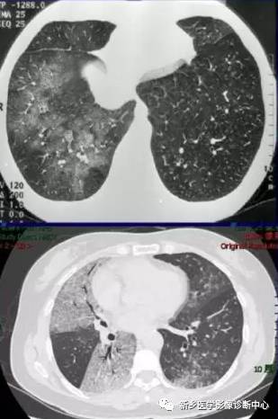 小心:6种症状体征与影像学表现不符的肺部疾病 小心:6种症状体征与影像学表现不符的肺部疾病