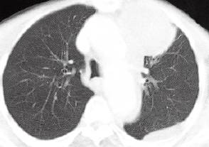 【病例】纵隔皮样囊肿伴破裂1例CT影像表现 【病例】纵隔皮样囊肿伴破裂1例CT影像表现