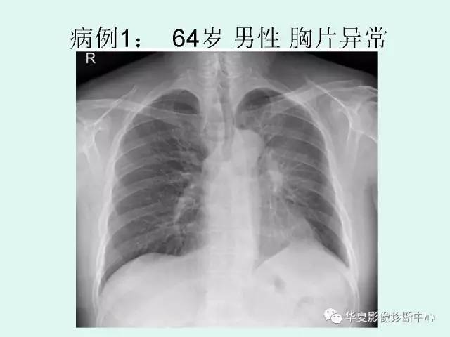 【PPT】少见胸部转移瘤——支气管内转移瘤