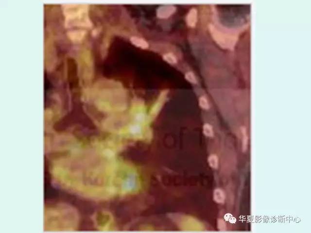 【PPT】少见胸部转移瘤——支气管内转移瘤