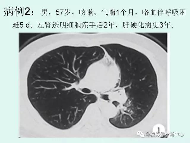 【PPT】少见胸部转移瘤——支气管内转移瘤