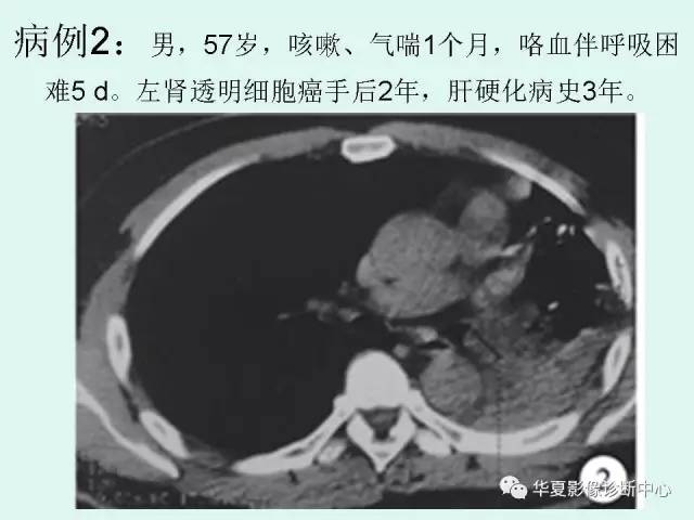 【PPT】少见胸部转移瘤——支气管内转移瘤