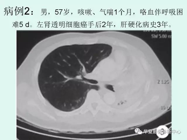 【PPT】少见胸部转移瘤——支气管内转移瘤