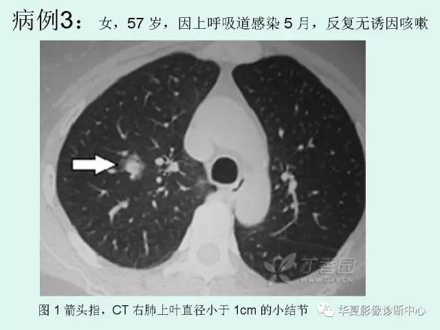 【PPT】少见胸部转移瘤——支气管内转移瘤