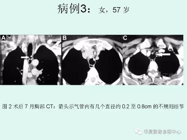 【PPT】少见胸部转移瘤——支气管内转移瘤
