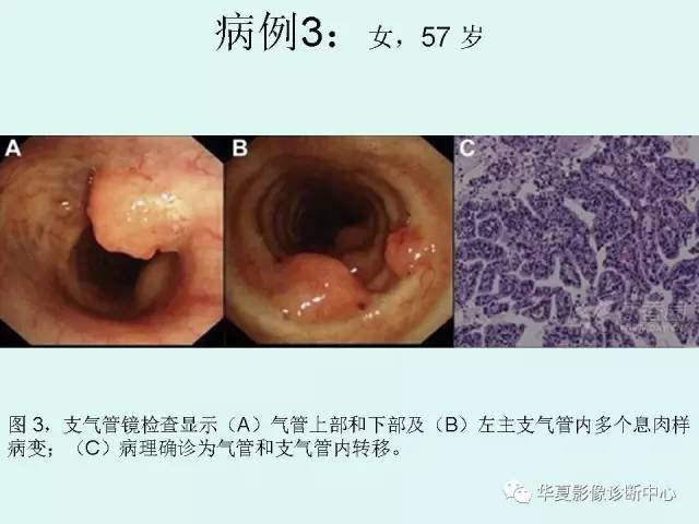 【PPT】少见胸部转移瘤——支气管内转移瘤