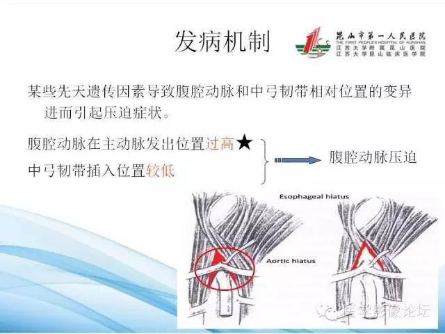【PPT】正中弓状韧带致腹腔动脉压迫综合征CTA表现 【PPT】正中弓状韧带致腹腔动脉压迫综合征CTA表现