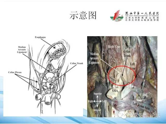 【PPT】正中弓状韧带致腹腔动脉压迫综合征CTA表现 【PPT】正中弓状韧带致腹腔动脉压迫综合征CTA表现