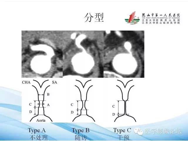 【PPT】正中弓状韧带致腹腔动脉压迫综合征CTA表现 【PPT】正中弓状韧带致腹腔动脉压迫综合征CTA表现