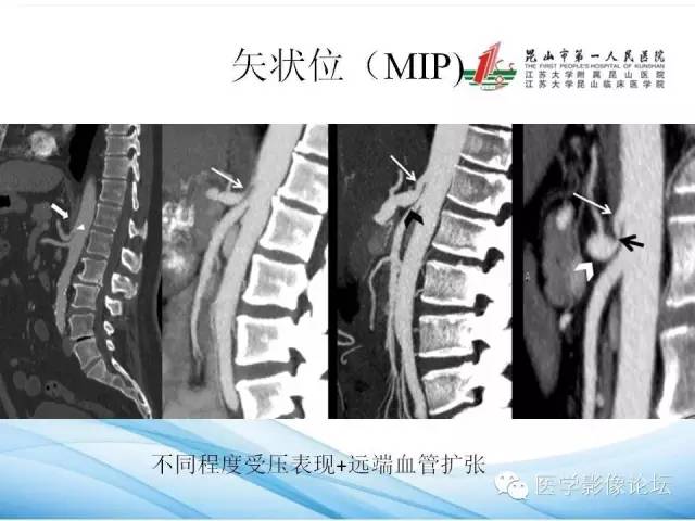 【PPT】正中弓状韧带致腹腔动脉压迫综合征CTA表现 【PPT】正中弓状韧带致腹腔动脉压迫综合征CTA表现