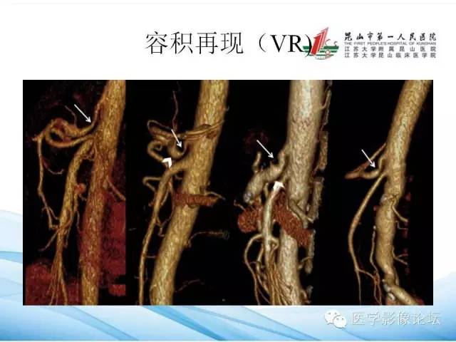 【PPT】正中弓状韧带致腹腔动脉压迫综合征CTA表现 【PPT】正中弓状韧带致腹腔动脉压迫综合征CTA表现