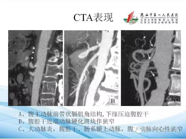 【PPT】正中弓状韧带致腹腔动脉压迫综合征CTA表现 【PPT】正中弓状韧带致腹腔动脉压迫综合征CTA表现