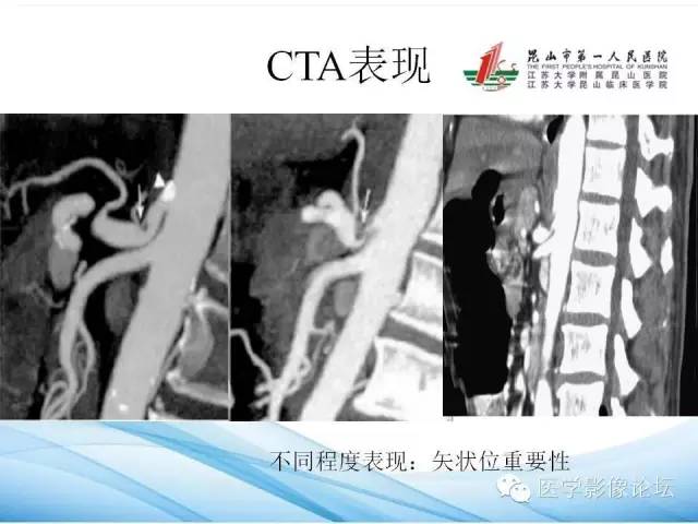 【PPT】正中弓状韧带致腹腔动脉压迫综合征CTA表现 【PPT】正中弓状韧带致腹腔动脉压迫综合征CTA表现