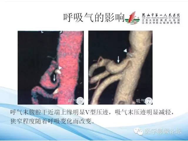 【PPT】正中弓状韧带致腹腔动脉压迫综合征CTA表现 【PPT】正中弓状韧带致腹腔动脉压迫综合征CTA表现
