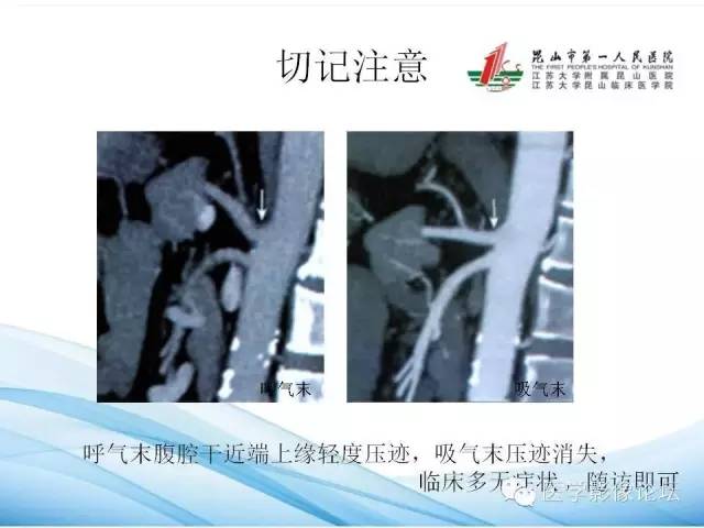 【PPT】正中弓状韧带致腹腔动脉压迫综合征CTA表现 【PPT】正中弓状韧带致腹腔动脉压迫综合征CTA表现