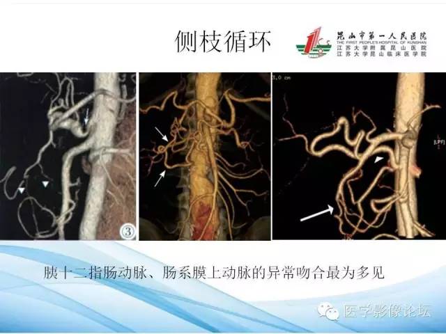 【PPT】正中弓状韧带致腹腔动脉压迫综合征CTA表现 【PPT】正中弓状韧带致腹腔动脉压迫综合征CTA表现