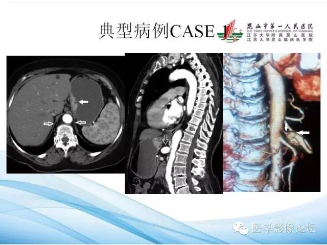 【PPT】正中弓状韧带致腹腔动脉压迫综合征CTA表现 【PPT】正中弓状韧带致腹腔动脉压迫综合征CTA表现