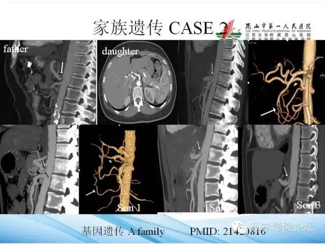 【PPT】正中弓状韧带致腹腔动脉压迫综合征CTA表现 【PPT】正中弓状韧带致腹腔动脉压迫综合征CTA表现