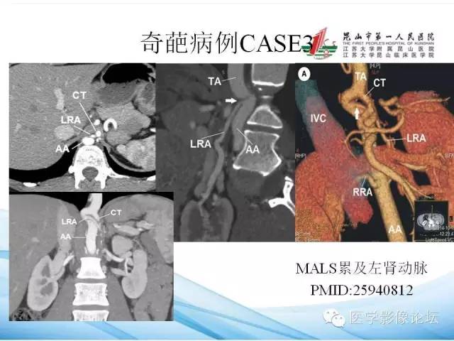 【PPT】正中弓状韧带致腹腔动脉压迫综合征CTA表现 【PPT】正中弓状韧带致腹腔动脉压迫综合征CTA表现