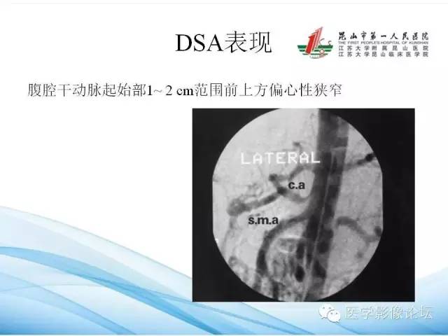 【PPT】正中弓状韧带致腹腔动脉压迫综合征CTA表现 【PPT】正中弓状韧带致腹腔动脉压迫综合征CTA表现
