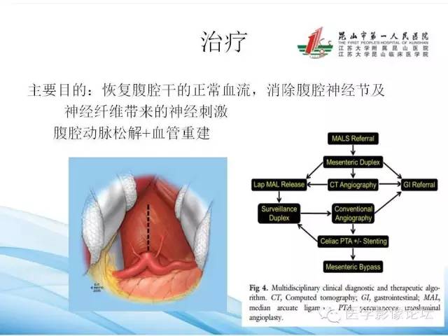 【PPT】正中弓状韧带致腹腔动脉压迫综合征CTA表现 【PPT】正中弓状韧带致腹腔动脉压迫综合征CTA表现