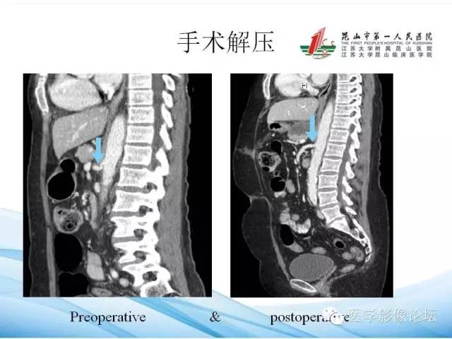 【PPT】正中弓状韧带致腹腔动脉压迫综合征CTA表现 【PPT】正中弓状韧带致腹腔动脉压迫综合征CTA表现