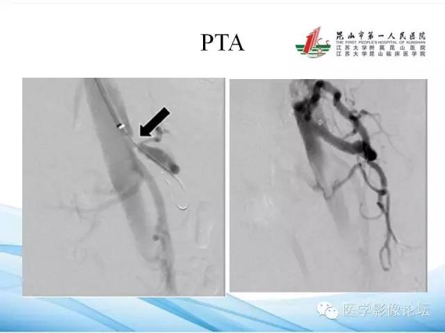 【PPT】正中弓状韧带致腹腔动脉压迫综合征CTA表现 【PPT】正中弓状韧带致腹腔动脉压迫综合征CTA表现