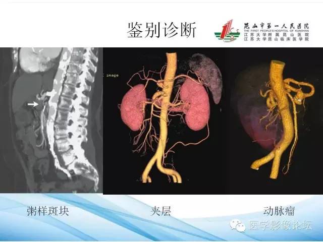 【PPT】正中弓状韧带致腹腔动脉压迫综合征CTA表现 【PPT】正中弓状韧带致腹腔动脉压迫综合征CTA表现