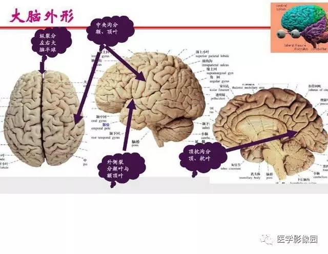 【PPT】脑梗塞影像学诊断