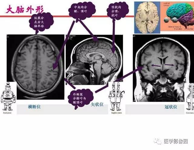 【PPT】脑梗塞影像学诊断