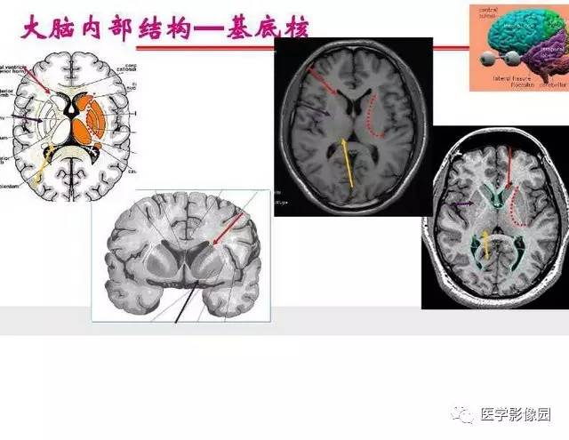 【PPT】脑梗塞影像学诊断