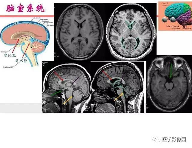 【PPT】脑梗塞影像学诊断