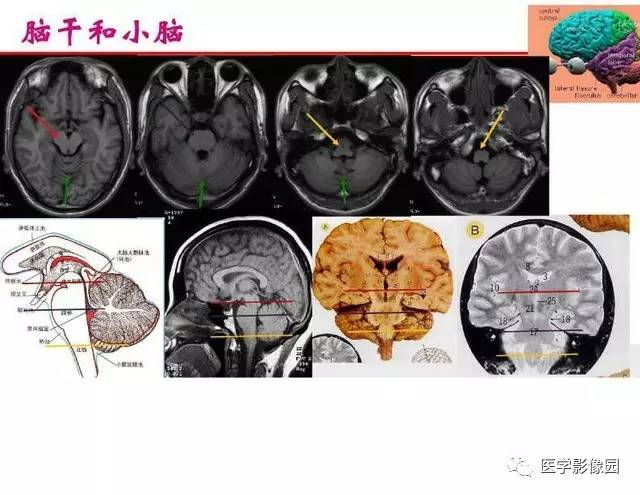 【PPT】脑梗塞影像学诊断