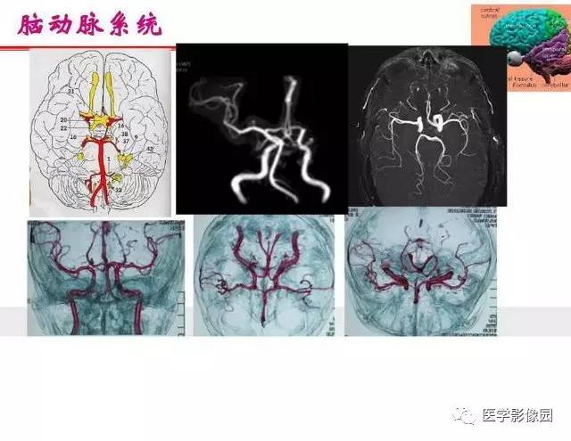 【PPT】脑梗塞影像学诊断