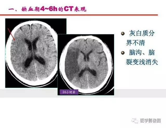【PPT】脑梗塞影像学诊断