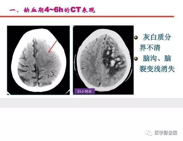 【PPT】脑梗塞影像学诊断