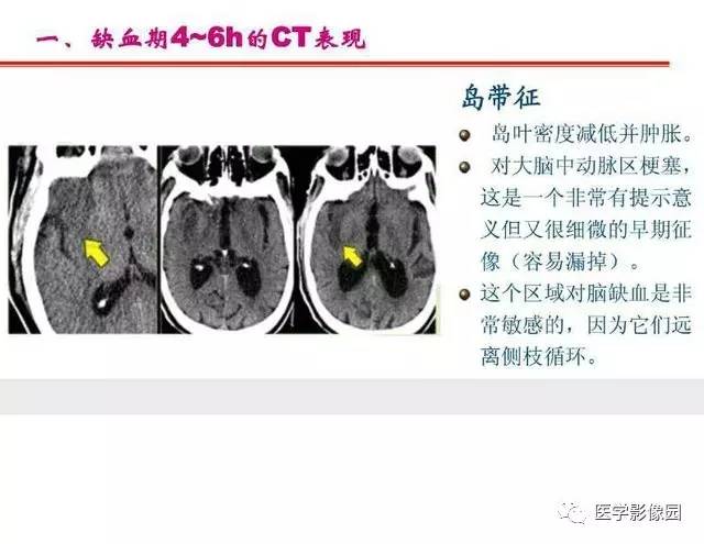 【PPT】脑梗塞影像学诊断