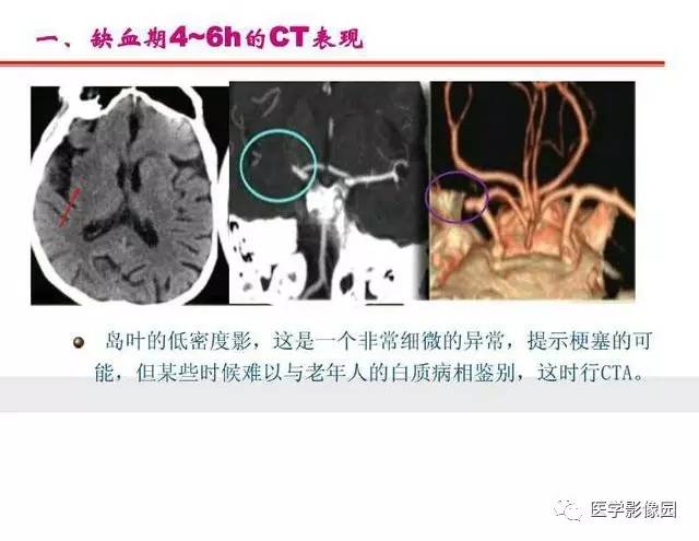 【PPT】脑梗塞影像学诊断