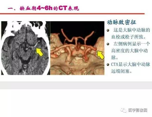 【PPT】脑梗塞影像学诊断
