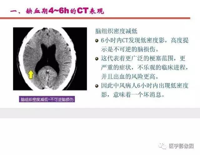 【PPT】脑梗塞影像学诊断