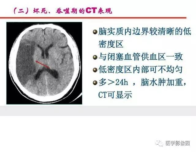 【PPT】脑梗塞影像学诊断