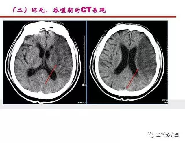 【PPT】脑梗塞影像学诊断