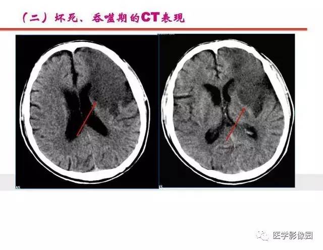 【PPT】脑梗塞影像学诊断