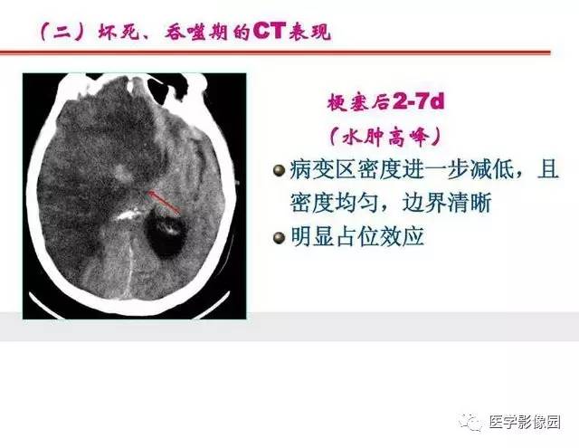 【PPT】脑梗塞影像学诊断